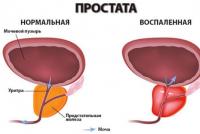 Простатит: видове, симптоми и причини за заболяването Как да се лекува възпаление на простатата