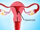 Ar galima vartoti vaistą Utrozhestan su vėlavimu menstruacijomis ir atnaujinti ciklą?