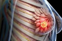 सर्जरी के लिए स्तन ग्रंथि के आकार का फाइब्रोएडीनोमा