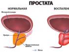 Prostatitis: vrste, simptomi in vzroki bolezni Kako zdraviti vnetje prostate