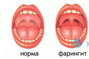 Symptoms of acute nasopharyngitis in adults, stages of the disease and methods of treatment