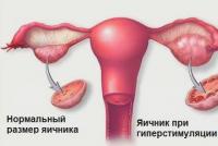 प्रोटोकॉल के दौरान और बाद में महिलाओं के लिए आईवीएफ की जटिलताएं आईवीएफ के बाद अंडाशय में दर्द क्यों होता है